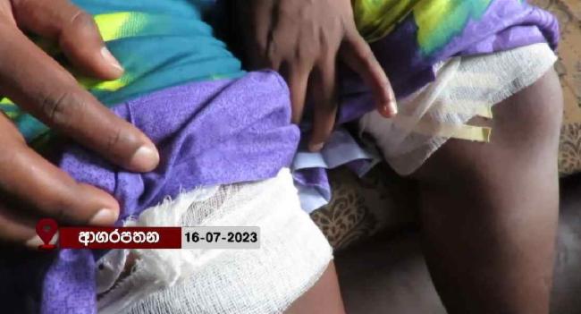 සිරුරේ අල්පෙතිනි සහිතව ආ කාන්තාව ගැන නිවේදනයක්..